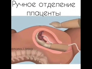 free в течение 30 минут после рождения ребенка должен родится послед если этого не происходит врачи могут заподозрить hd