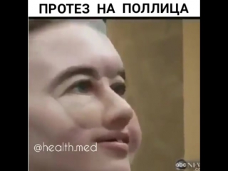 free девушке установили протез в виде носа и глаз чтобы она чувствовала себя более полноценно hd