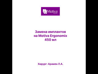free результат вторичной маммопластики и замены имплантов на motiva ergonomix hd