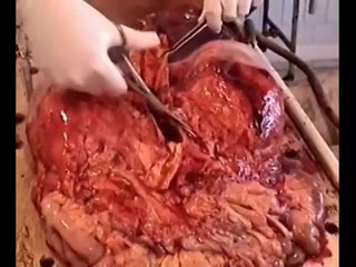 free патологическая анатомия аутопсия autopsy анатомичка препарирование тела hd