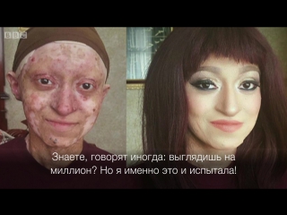 free у нее редкое заболевание кожи но она не теряет оптимизма hd