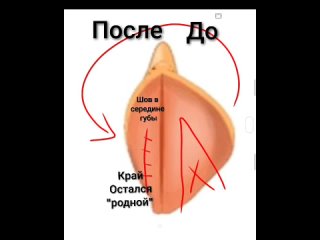 free говоря проще лабиопластика это процедура которая уменьшает длину малых половых губ меняет их форму hd
