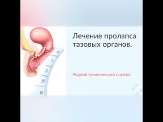 free видеофрагмент операции клинического случая успешной беременности после лапароскопической сакрогистеропексии hd