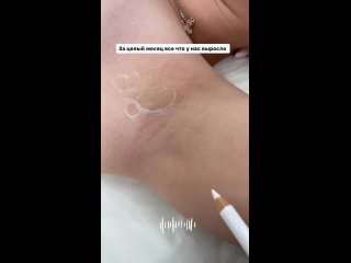 free видео от лазерная эпиляция восковая армавир nasti sugari hd