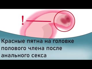 free красные пятна на половом члене после анального секса hd