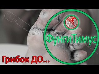free лечение грибка кожи на ноге за 3 месяца до и после крем фунгитимус hd