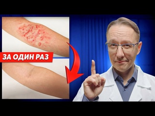 free как вылечить экзему без врачей и лекарств проверенный метод hd