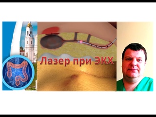 free лазерная операция эпителиальный копчиковый ход киста копчика экх пилонидальная болезнь hd