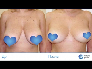 free до и после редукционная маммопластика выполнена в клинике doctorplastic hd