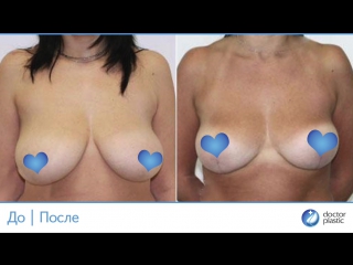 free до и после редукционная маммопластика выполнена в клинике doctorplastic hd