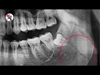 free тау сломавший челюсть из за плавок остался на воле hd
