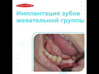 free имплантация зубов жевательной группы премоляров в клинике столица hd