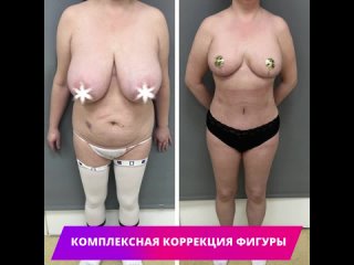 free выполнена комплексная коррекция фигуры подтяжка и уменьшение груди липоабдоминопластика hd