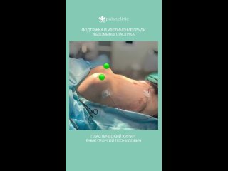 free увеличение груди с периареолярной подтяжкой и липоабдоминопластика в клинике пульс пластический хирург еник г л hd