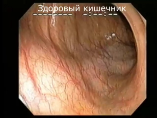 free колоноскопия кишечника под наркозом процедура очищение организма от шлаков и токсинов в домашних условиях отзывы цена hd