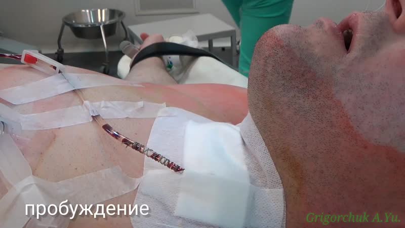 free внутри операционной live surgery циркулярная резекция трахеи стеноз hd